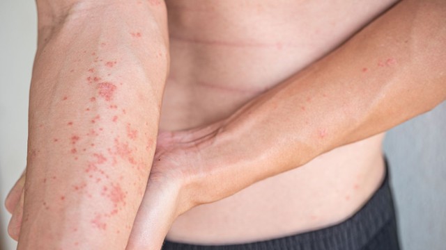 bai-viet/phac-do-dieu-tri-viem-da-di-ung-nhu-the-nao-phuong-phap-chan-doan-viem-da-di-ung.html