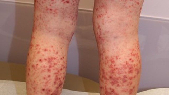 bai-viet/phac-do-dieu-tri-viem-mao-mach-di-ung-o-tre-em.html