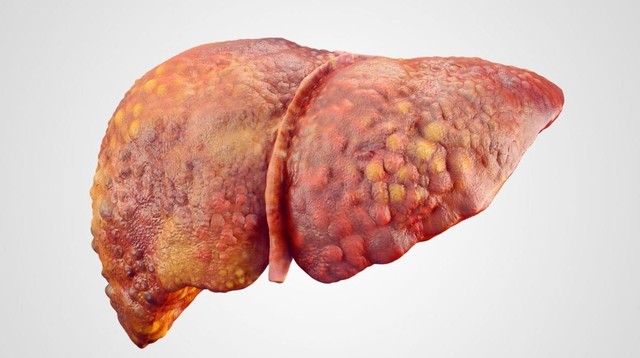 bai-viet/phac-do-dieu-tri-xo-gan-cua-bo-y-te.html