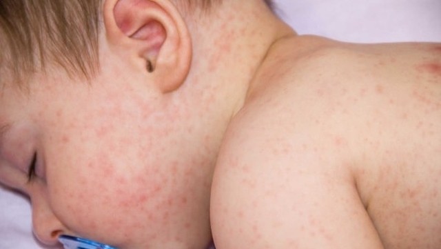 bai-viet/phac-do-tiep-can-lupus-ban-do-he-thong-o-nguoi-tre-ma-ban-nen-biet-56827.html