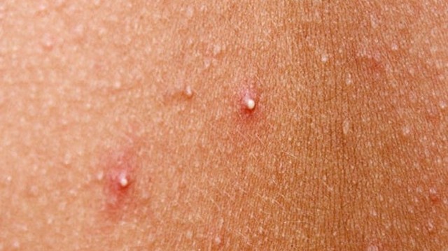 bai-viet/phai-lam-sao-khi-mong-bi-noi-mun-do.html