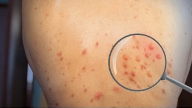 bai-viet/phan-biet-hinh-anh-benh-dau-mua-khi.html