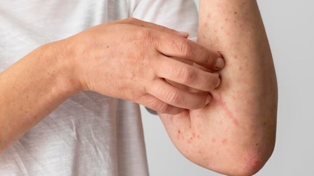 bai-viet/phat-ban-sot-xuat-huyet-co-ngua-khong-cach-giam-ngua-khi-bi-sot-xuat-huyet.html