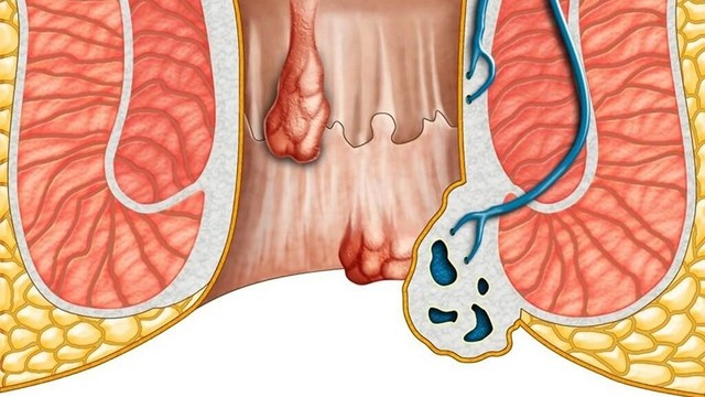 bai-viet/phau-thuat-cat-tri-co-phai-nam-vien-khong.html