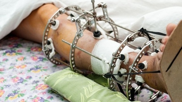 bai-viet/phau-thuat-keo-dai-chan-doi-chan-dai-khong-con-la-mo-uoc-nua.html