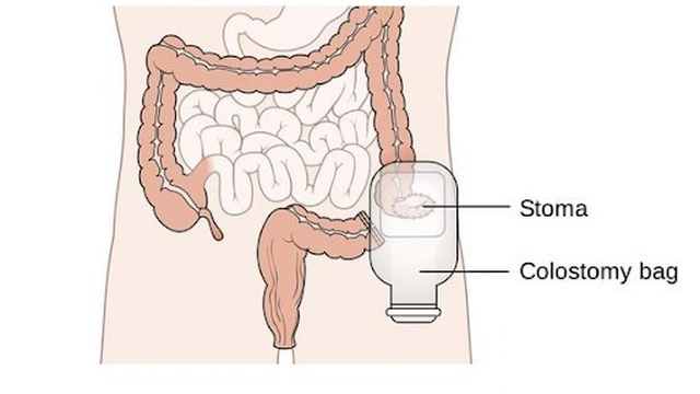 bai-viet/phau-thuat-lam-hau-mon-nhan-tao-56982.html