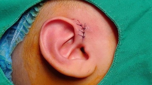 bai-viet/thong-tin-can-biet-ve-phuong-phap-phau-thuat-lay-duong-ro-luan-nhi-59283.html