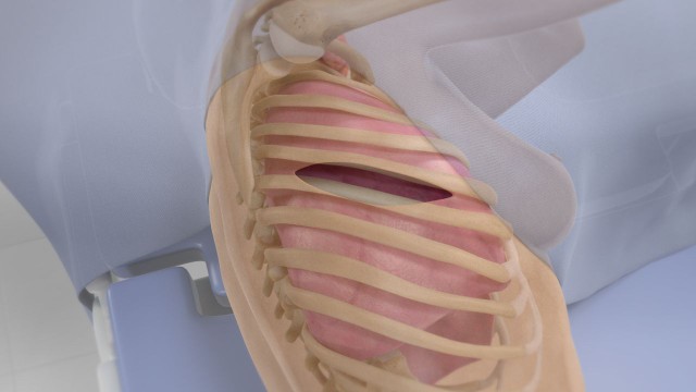 bai-viet/phau-thuat-mo-nguc-tham-do-duoc-su-dung-khi-nao.html