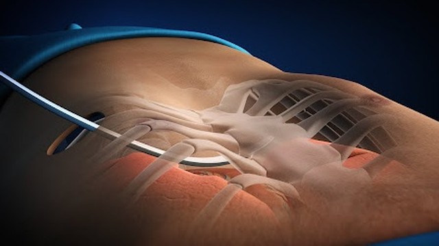 bai-viet/phau-thuat-nuss-va-nhung-dieu-can-biet-61223.html