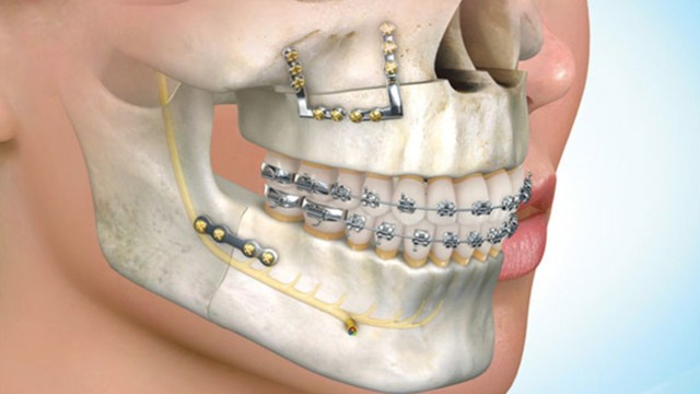 bai-viet/phau-thuat-rang-ho-va-cach-cham-soc-sau-phau-thuat-61352.html