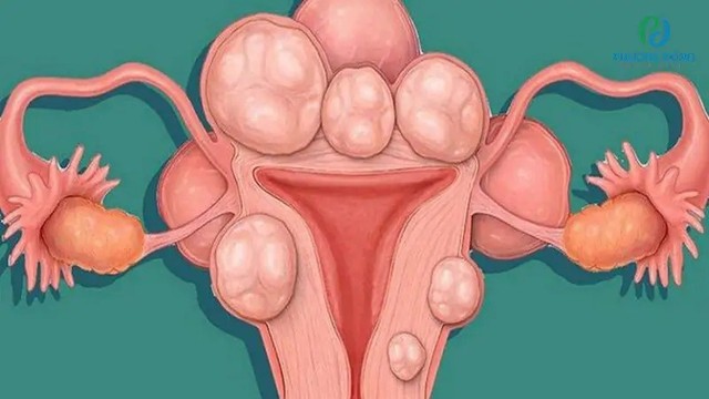 bai-viet/phau-thuat-tao-hinh-tu-cung-bang-phuong-phap-strassman.html