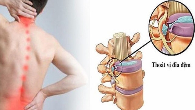 bai-viet/phau-thuat-thoat-vi-dia-dem-cot-song-cac-thong-tin-quan-trong.html