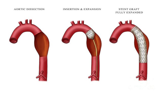 bai-viet/phinh-dong-mach-chu-nguyen-nhan-trieu-chung-va-cach-dieu-tri-hieu-qua.html