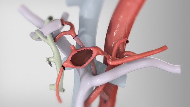 benh/phinh-dong-mach-gan.html