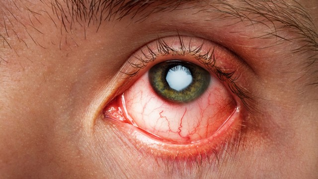 bai-viet/phu-ket-mac-nguyen-nhan-trieu-chung-va-cach-xu-tri-hieu-qua.html