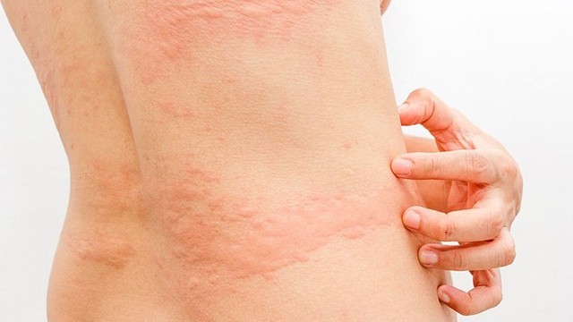 bai-viet/phu-nu-bi-noi-me-day-sau-sinh-uong-thuoc-gi-54534.html