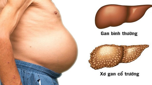 bai-viet/phuong-phap-chua-benh-xo-gan-co-truong-giai-doan-cuoi-71351.html