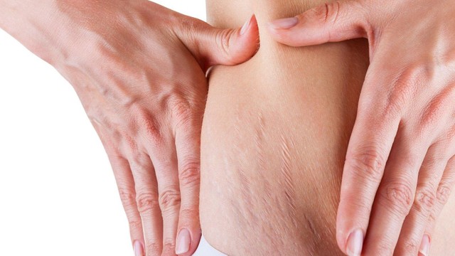 bai-viet/phuong-phap-dieu-tri-tinh-trang-cang-da-bung-hieu-qua.html