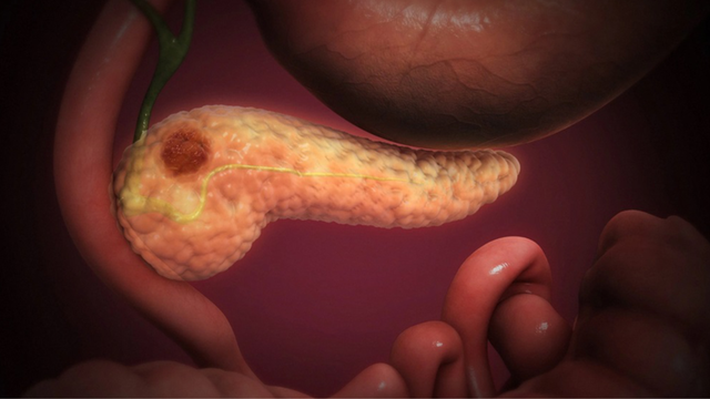 bai-viet/tong-quan-cac-phuong-phap-dieu-tri-ung-thu-tuy-hien-nay.html