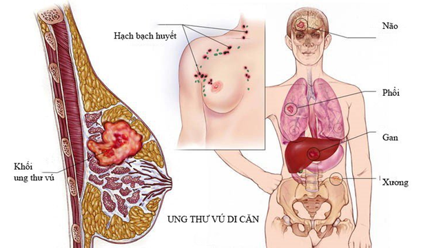 bai-viet/phuong-phap-dieu-tri-ung-thu-vu-di-can-phoi-56583.html