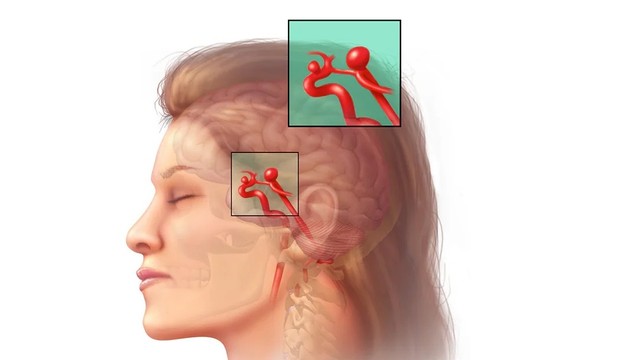 bai-viet/tim-hieu-chi-tiet-ve-phuong-phap-nut-tui-phinh-dong-mach-nao.html