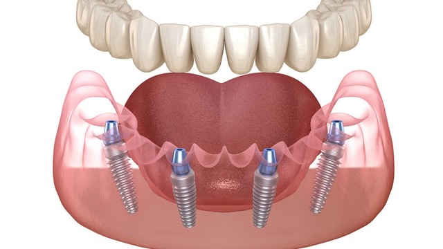 bai-viet/phuong-phap-trong-rang-all-on-4-tong-quan-uu-diem-va-quy-trinh-cay-ghep.html