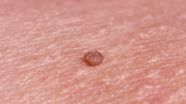 bai-viet/phuong-phap-xit-al-co-het-sui-mao-ga-khong-cac-bien-phap-dieu-tri-sui-mao-ga.html