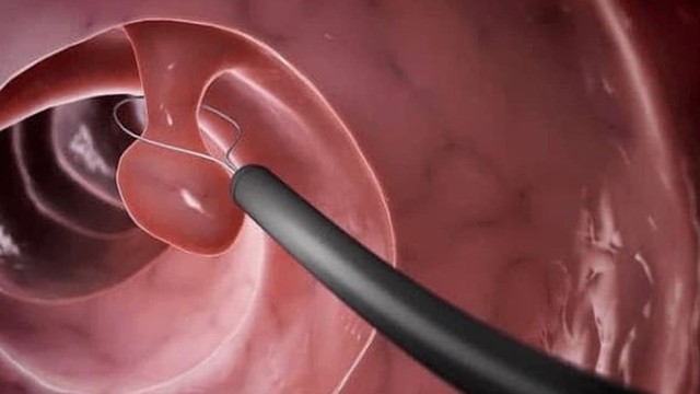 bai-viet/polyp-da-day-co-nguy-hiem-khong-nguyen-nhan-va-cach-phong-ngua.html