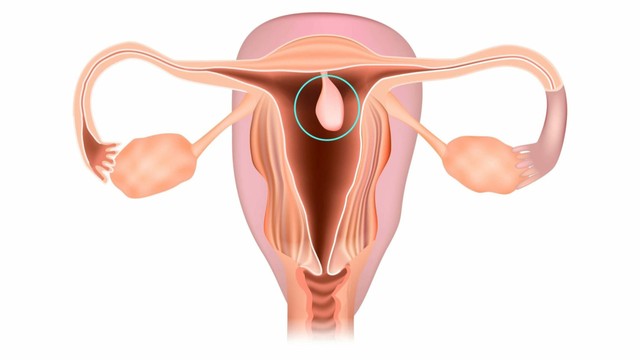 benh/polyp-buong-tu-cung.html