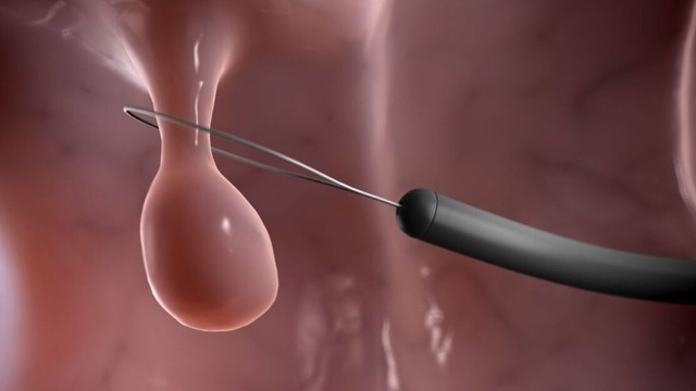 bai-viet/polyp-dai-trang-nghich-san-va-nhung-dieu-can-biet.html