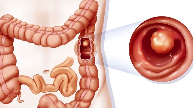 bai-viet/polyp-loan-san-dai-trang-nguyen-nhan-va-cach-dieu-tri.html