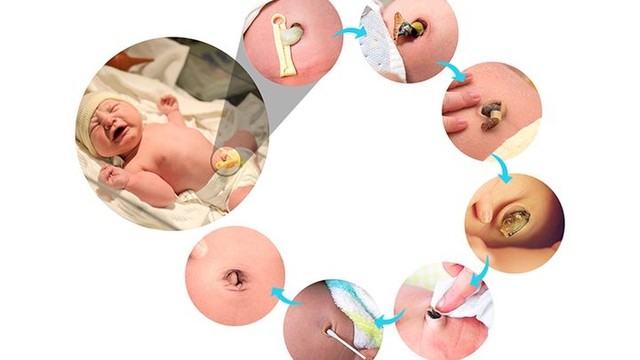 bai-viet/polyp-ron-o-tre-so-sinh-dau-hieu-nhan-biet-va-cach-dieu-tri.html