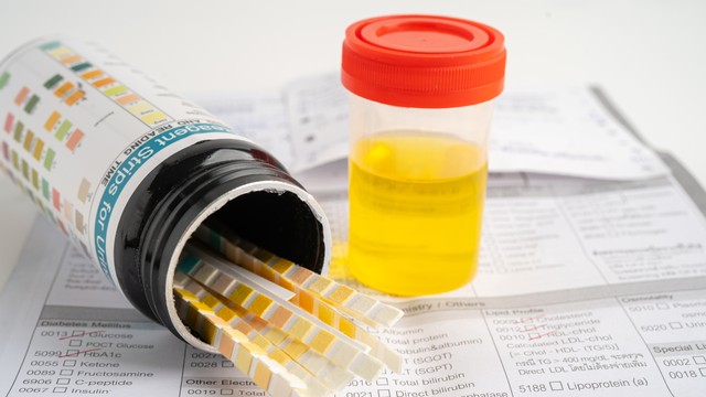 bai-viet/protein-trong-nuoc-tieu-bao-nhieu-la-binh-thuong-moi-lien-he-giua-protein-nieu-va-voi-cac-benh-ly-pho-bien.html