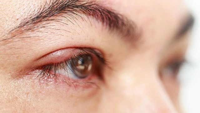 bai-viet/quam-mi-la-gi-tinh-trang-nay-co-nguy-hiem-khong.html