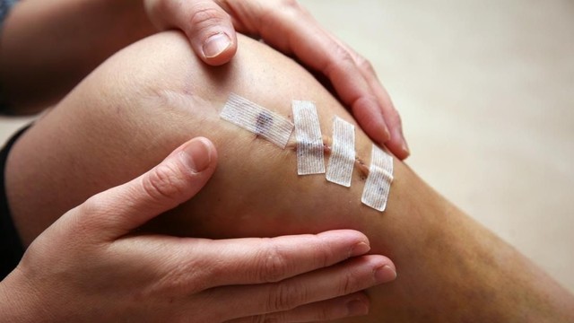 bai-viet/rach-sun-chem-co-da-bong-duoc-khong.html