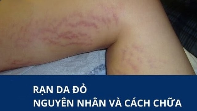 bai-viet/ran-da-chan-mau-do-nguyen-nhan-va-cach-khac-phuc-57690.html