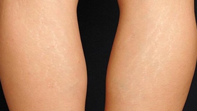 bai-viet/ran-da-chan-mau-trang-nguyen-nhan-va-cach-khac-phuc-57711.html