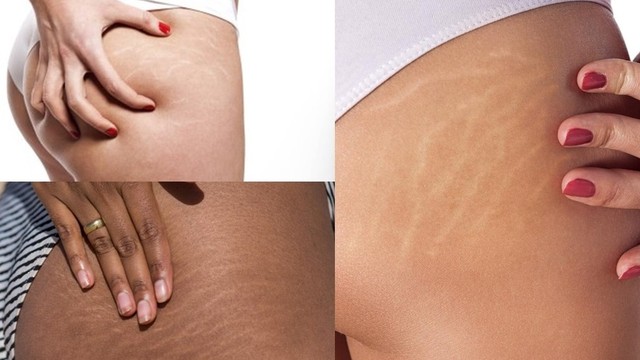 bai-viet/ran-da-mong-khi-mang-thai-phai-lam-sao-de-het-57688.html