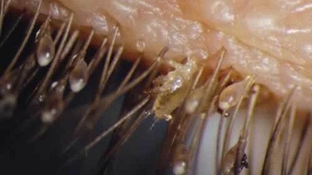 bai-viet/ran-mu-mi-mat-co-chua-duoc-khong-64102.html