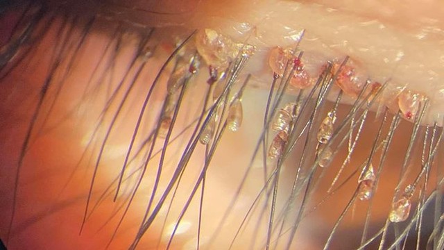 bai-viet/ran-mu-o-tre-em-nguyen-nhan-va-cach-phong-ngua-64227.html