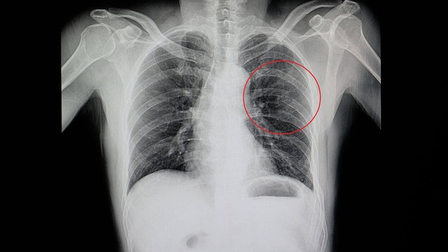 bai-viet/ran-xuong-suon-nguyen-nhan-dau-hieu-va-cach-phong-ngua.html