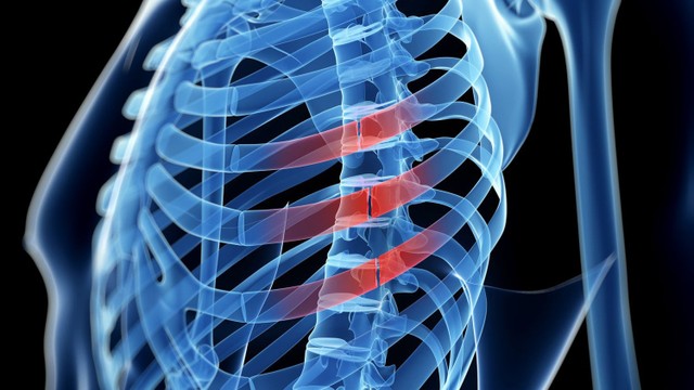 bai-viet/ran-xuong-suon-bao-lau-thi-khoi-ran-xuong-suon-co-nguy-hiem-khong.html