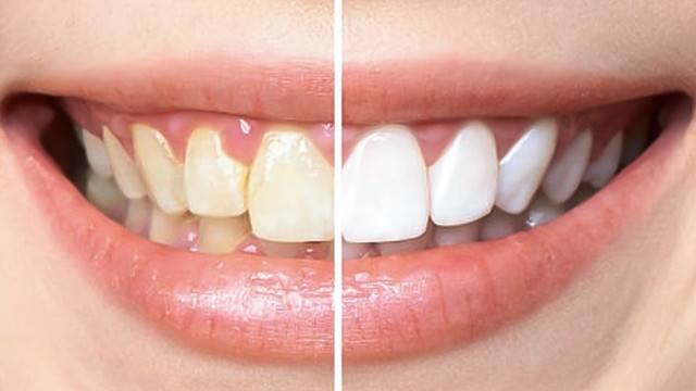 bai-viet/rang-den-co-tay-trang-duoc-khong-tay-trang-rang-co-hai-gi-khong.html