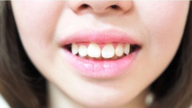 bai-viet/rang-ho-nhe-nguyen-nhan-tac-hai-va-phuong-phap-khac-phuc.html