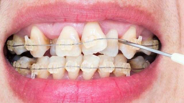 bai-viet/rang-khenh-2-ben-co-nieng-duoc-khong-dung-phuong-phap-nao.html