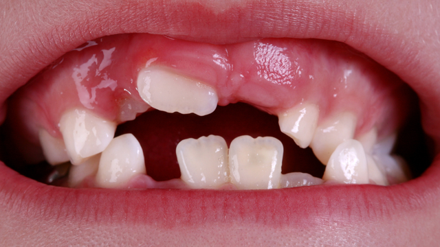 bai-viet/rang-khenh-ham-duoi-co-dac-diem-gi-2-cach-cai-thien-pho-bien-hien-nay.html