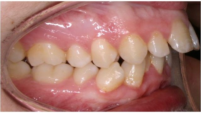 bai-viet/rang-loi-xi-la-gi-nguyen-nhan-va-cach-dieu-tri.html