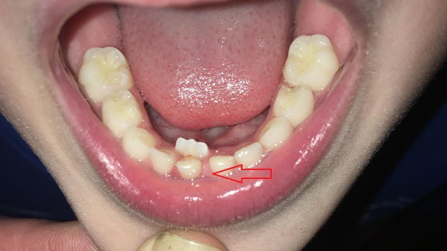 bai-viet/rang-sua-khong-rung-nguyen-nhan-va-cach-xu-ly.html