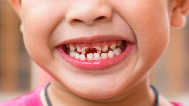 bai-viet/rang-sua-la-gi-thong-tin-quan-trong-can-biet-ve-rang-sua.html