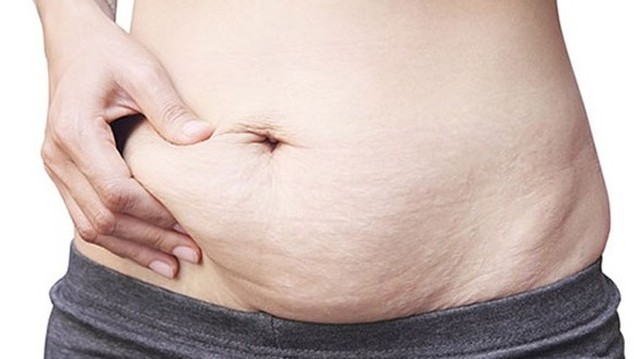 bai-viet/tim-hieu-ve-uu-nhuoc-diem-cua-cach-xoa-ran-da-sau-sinh-57024.html